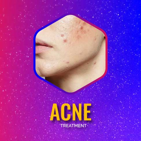 Acne1.jpg