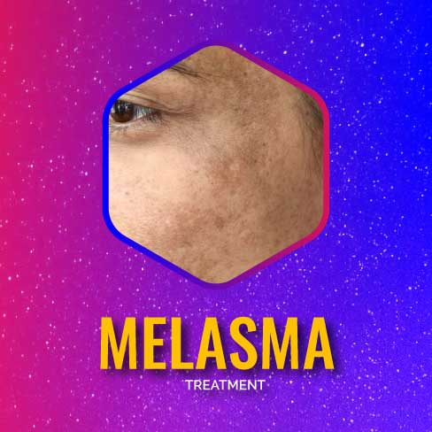 Melasma10